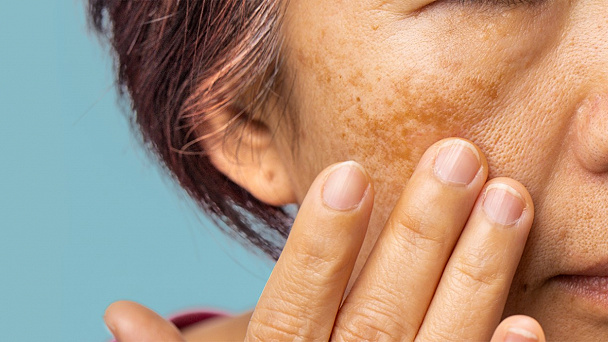 Trápia vás pigmentové škvrny? Doprajte pleti zimnú regeneráciu 