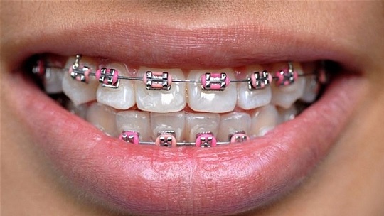 Obrázok Krivé zuby u detí môžu za zubné kazy i bolesti hlavy. Aké sú možnosti riešenia?