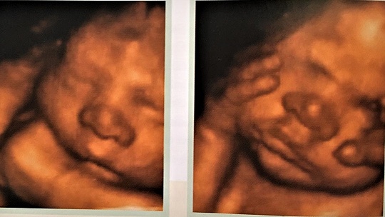 Obrázok Tajomný svet v maternici. Treba sa báť ultrazvuku v tehotenstve?